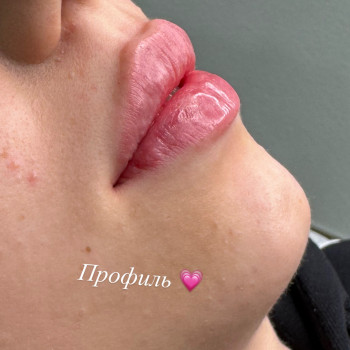 Збільшення губ
                    Косметолог Анна Вінниця