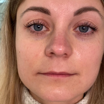 Збільшення губ
                    Косметолог Анна Вінниця