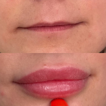 Збільшення губ
                    Косметолог Анна Вінниця