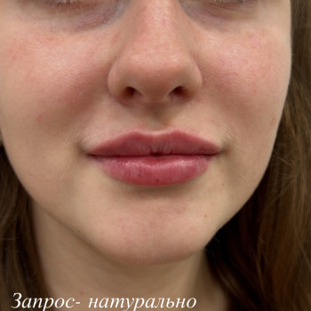 Збільшення губ
                    Косметолог Анна Вінниця