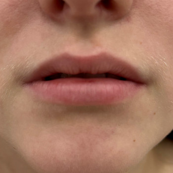 Збільшення губ
                    Косметолог Анна Вінниця