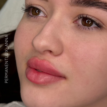 Збільшення губ
                    Косметолог Анна Вінниця