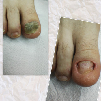 Фото из портфолио специалиста Ольга Живец (подолог, Чернигов)