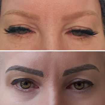 Видалення тату