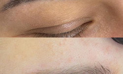 Видалення татуажу Мастер перманентного макияжа Тетяна Ивано-Франковск