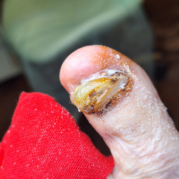 Звернулась пані 86р. Не може зрізати ніготь. Болить, дпвить. Не може вдягти та носити взуття без бол...