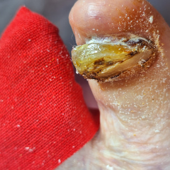 Це друга нога пані 86р. Проблема така ж
Зачистили. Дали рекомендації по догляду