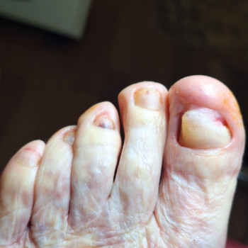 Після зачисткт н/п у пані 86р.