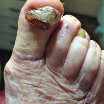 Це друга нога з н/п пані 86р. Проблема таж. 
Зачистили, дали рекомендації по догляду.