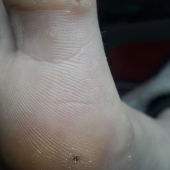 Середина роботи з бородавками. Уявіть термін роботи. Чим скоріш, тим краще