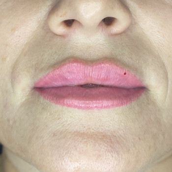 Збільшення губ
                    Косметолог-ін'єкціоніст Аліна Харків