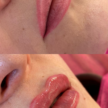 Збільшення губ
                    Косметолог-ін'єкціоніст Аліна Харків