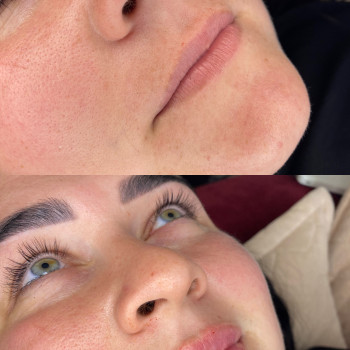 Збільшення губ
                    Косметолог-ін'єкціоніст Аліна Харків