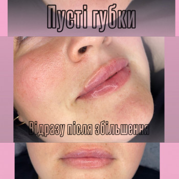 Збільшення губ
                    Косметолог-ін'єкціоніст Аліна Харків