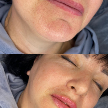 Збільшення губ
                    Косметолог-ін'єкціоніст Аліна Харків