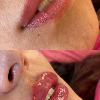 Збільшення губ
                    Косметолог-инъекционист Аліна Харьков