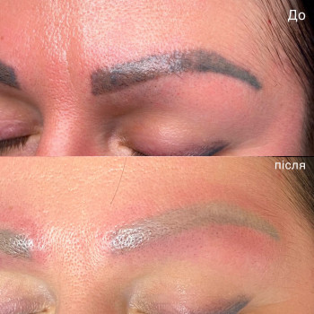 Лазерное удаление татуаж, татуировок
                    Мастер перманентного макияжа Таня Полтава