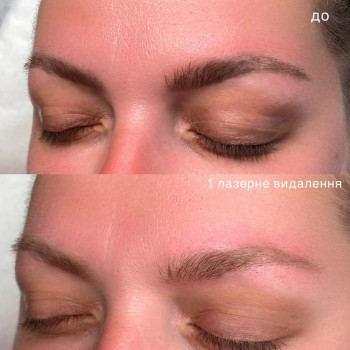 Лазерное удаление татуаж, татуировок
                    Мастер перманентного макияжа Таня Полтава