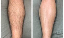 Чоловіча лазерна епіляція Студия лазерной эпиляции Центр лазерної косметології Луцк