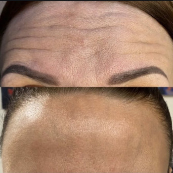 Результат до/після процедури ботулінотерапії