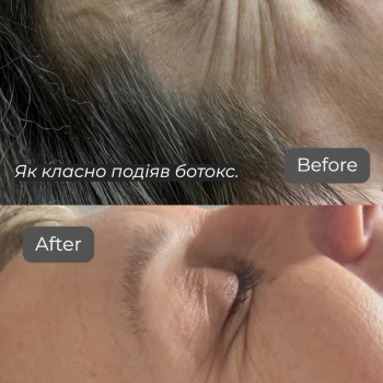 Ботулінотерапія навколо очей