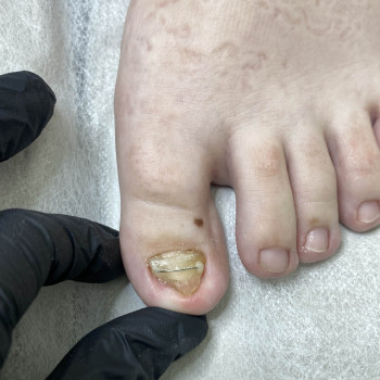 Травма нігтя
                    Подолог Наталья Львов