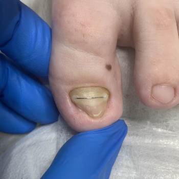 Травма нігтя
                    Подолог Наталья Львов