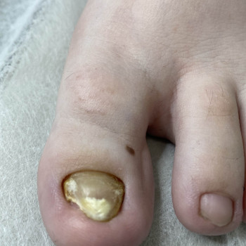 Травма нігтя
                    Подолог Наталья Львов