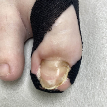 Травма нігтя
                    Подолог Наталья Львов