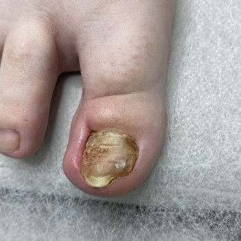 Травма нігтя
                    Подолог Наталья Львов