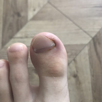 Врослий ніготь
                    Подолог Наталья Львів