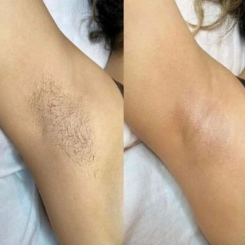   пахв # удаление волос подмышки 