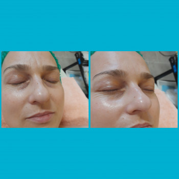  
До и после первой процедуры пилинга