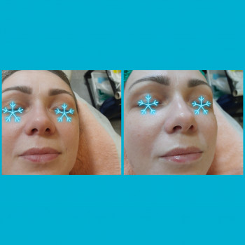  
 
Видимое омоложение за 1 процедуру(без фильтра фото до и после:45 мин разница)