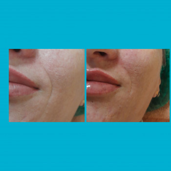  
 
До и после через