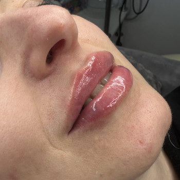 збільшення губ