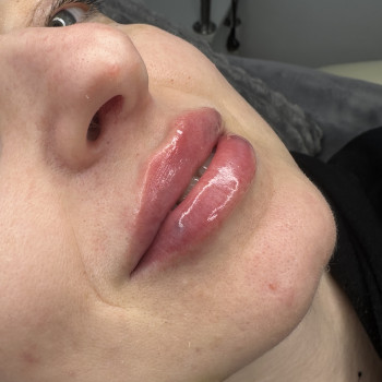 Контурна пластика губ