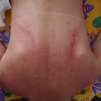 Реабилитация после бронхита.
 
 
 