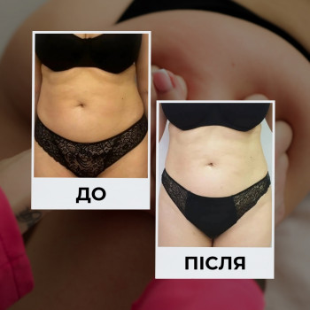 Результат 8 сенасів антицелюілтної програми
         