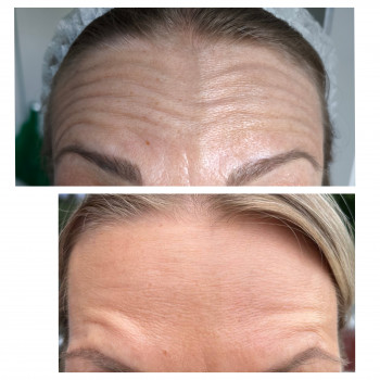  #ботокскиїв #косметологкиїв #косметологіякиїв