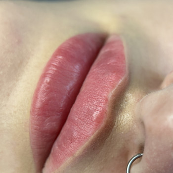 Контурна пластика губ.