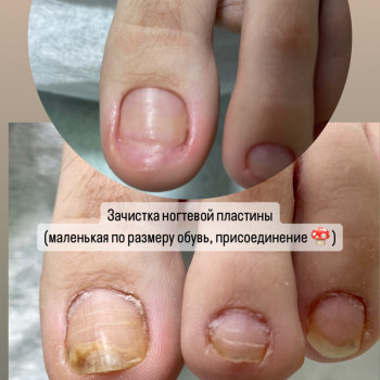 Подологическая обработка ногтей