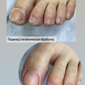 Гигиенический педикюр