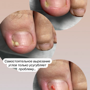 Вросший ноготь