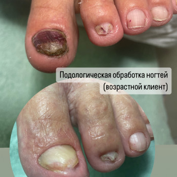 Подологическая обработка ногтей