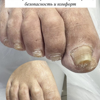 Подологический педикюр