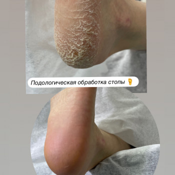 Обработка стопы