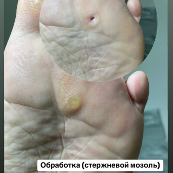 Подошвенная бородавка