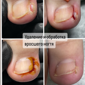 Вросший ноготь