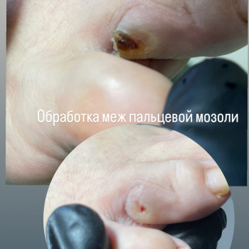 Стержневая мозоль